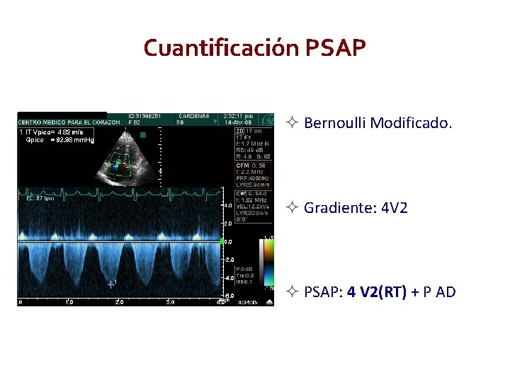 Cuantificación PSAP Bernoulli Modificado. Gradiente: 4 V 2 PSAP: 4 V 2(RT) + P