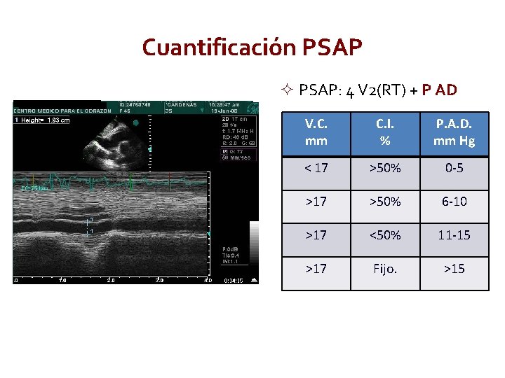 Cuantificación PSAP: 4 V 2(RT) + P AD V. C. mm C. I. %