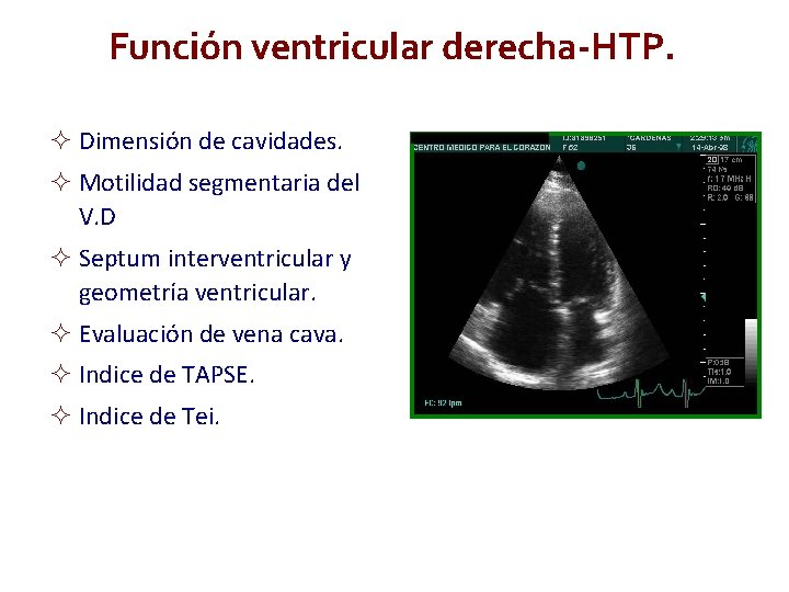 Función ventricular derecha-HTP. Dimensión de cavidades. Motilidad segmentaria del V. D Septum interventricular y Función ventricular derecha-HTP. Dimensión de cavidades. Motilidad segmentaria del V. D Septum interventricular y