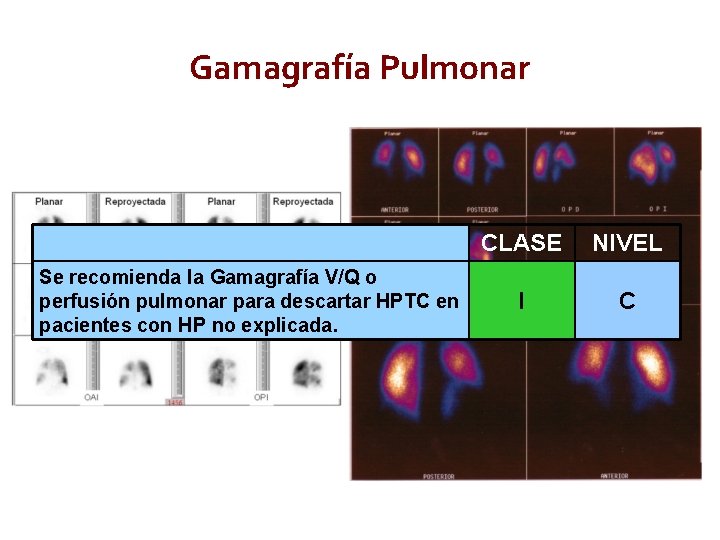 Gamagrafía Pulmonar Se recomienda la Gamagrafía V/Q o perfusión pulmonar para descartar HPTC en