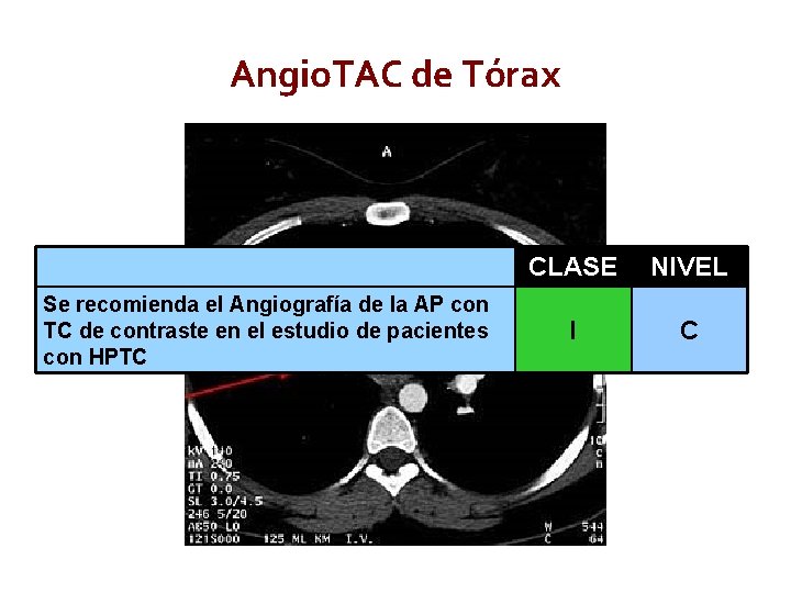 Angio. TAC de Tórax Se recomienda el Angiografía de la AP con TC de Angio. TAC de Tórax Se recomienda el Angiografía de la AP con TC de