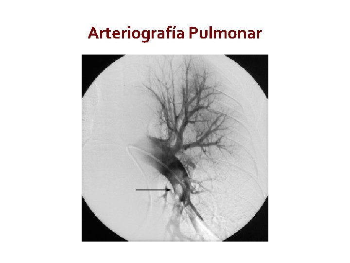 Arteriografía Pulmonar 