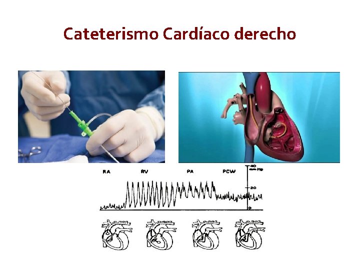 Cateterismo Cardíaco derecho 