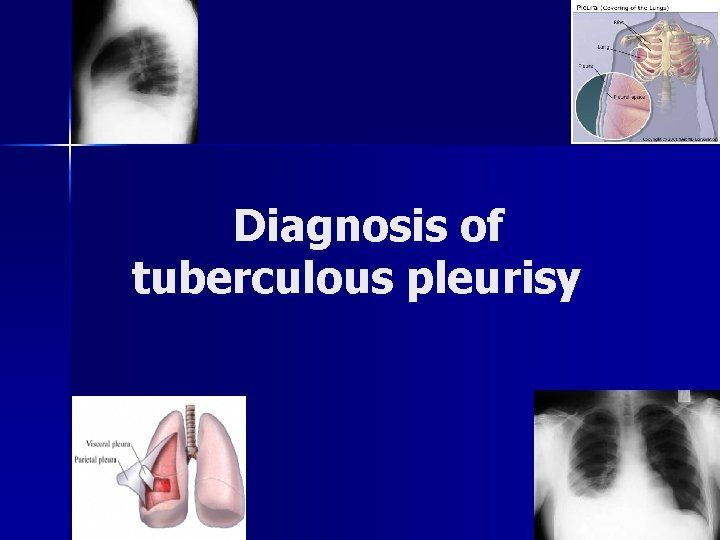 Diagnosis of tuberculous pleurisy 