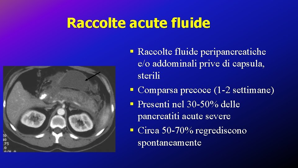 Raccolte acute fluide § Raccolte fluide peripancreatiche e/o addominali prive di capsula, sterili §