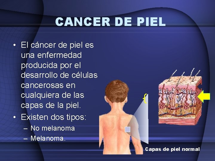 CANCER DE PIEL • El cáncer de piel es una enfermedad producida por el