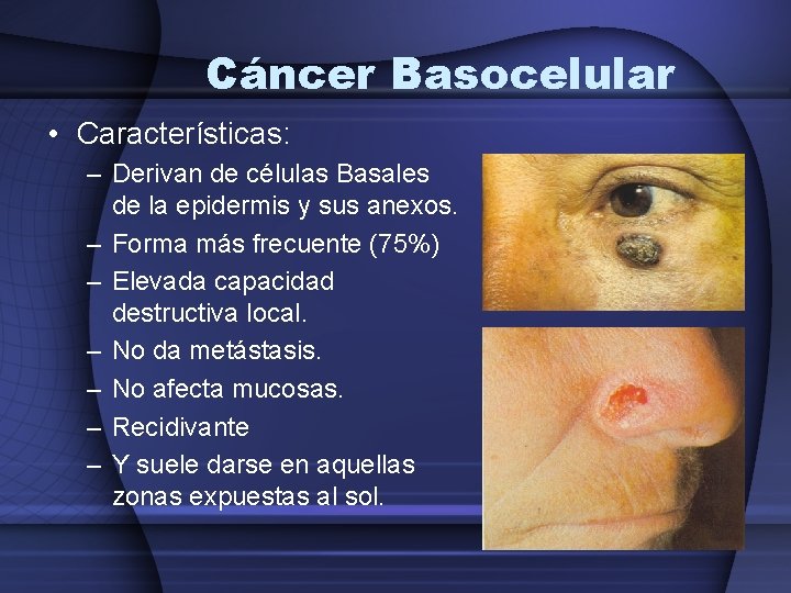 Cáncer Basocelular • Características: – Derivan de células Basales de la epidermis y sus