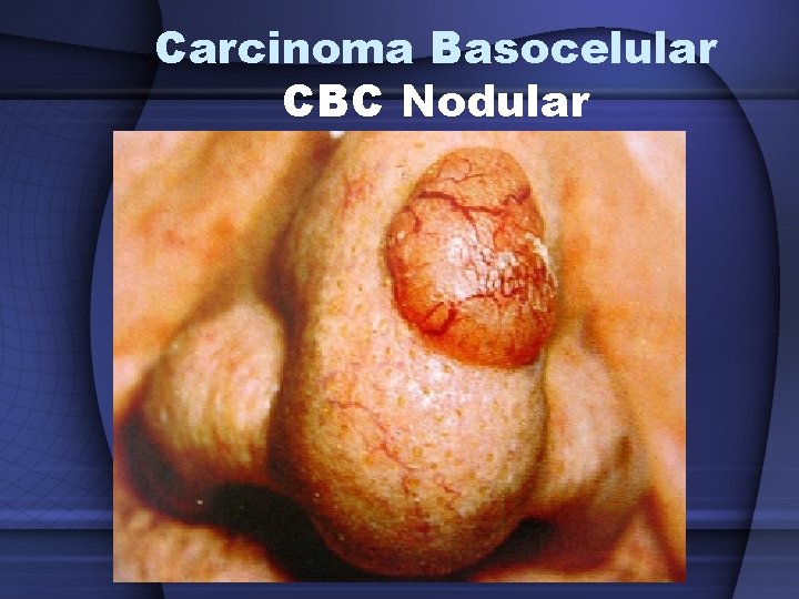 Carcinoma Basocelular CBC Nodular 