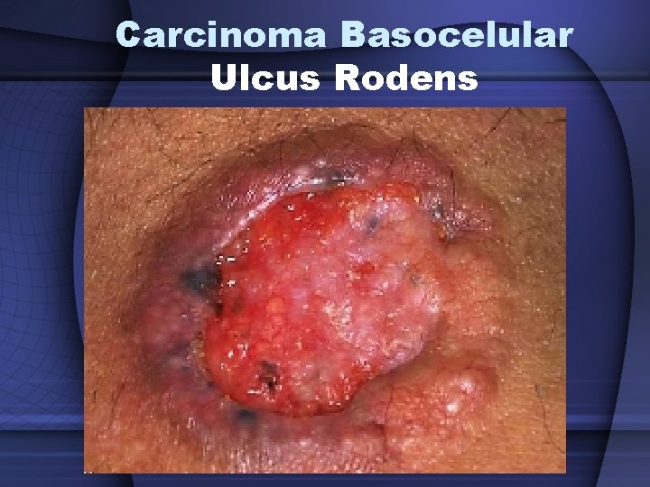 Carcinoma Basocelular Ulcus Rodens 