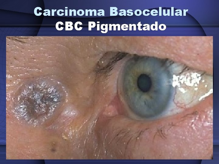 Carcinoma Basocelular CBC Pigmentado 
