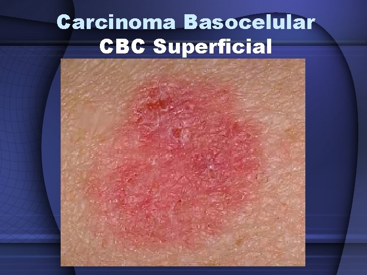 Carcinoma Basocelular CBC Superficial 