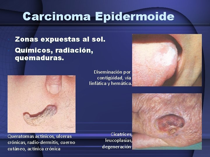 Carcinoma Epidermoide Zonas expuestas al sol. Químicos, radiación, quemaduras. Diseminación por contigüidad, vía linfática