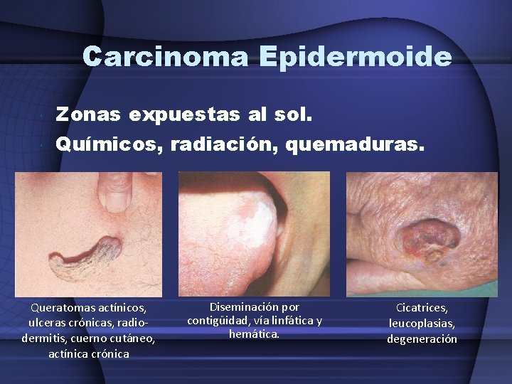 Carcinoma Epidermoide Zonas expuestas al sol. Químicos, radiación, quemaduras. Queratomas actínicos, ulceras crónicas, radiodermitis,