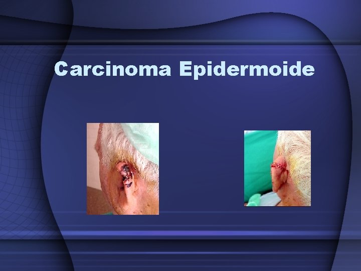 Carcinoma Epidermoide 