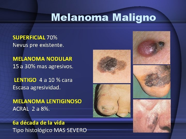 Melanoma Maligno SUPERFICIAL 70% Nevus pre existente. MELANOMA NODULAR 15 a 30% mas agresivos.