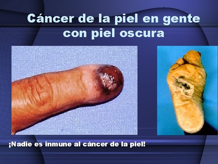 Cáncer de la piel en gente con piel oscura ¡Nadie es inmune al cáncer