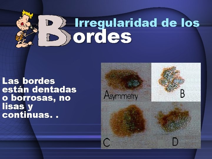 Irregularidad de los ordes Las bordes están dentadas o borrosas, no lisas y continuas.