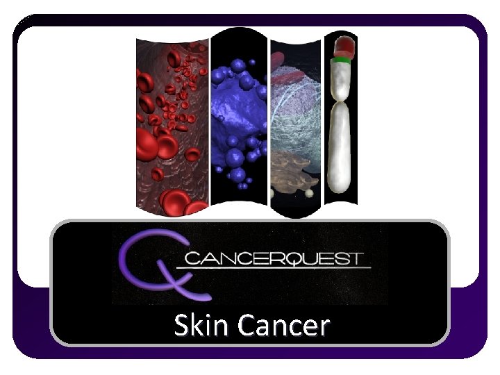 Skin Cancer 