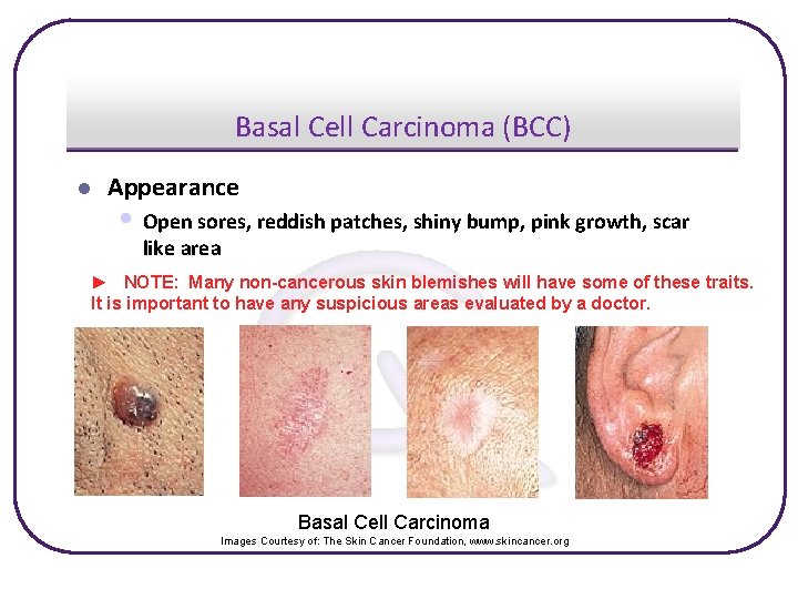 Basal Cell Carcinoma (BCC) l Appearance • Open sores, reddish patches, shiny bump, pink