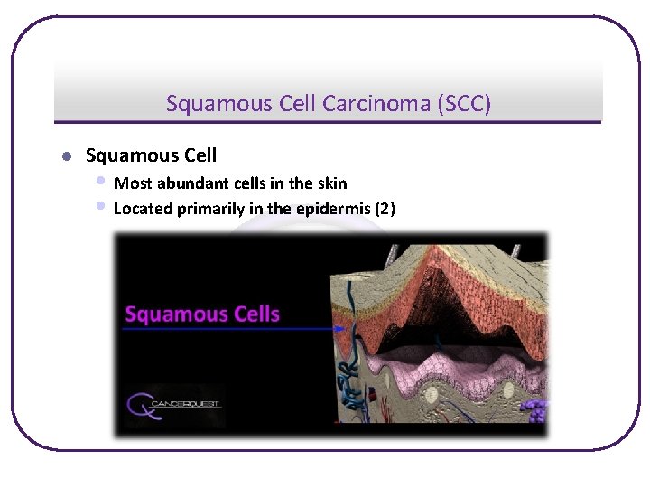 Squamous Cell Carcinoma (SCC) l Squamous Cell • Most abundant cells in the skin