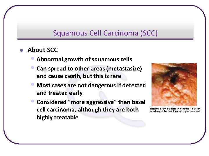 Squamous Cell Carcinoma (SCC) l About SCC • Abnormal growth of squamous cells •