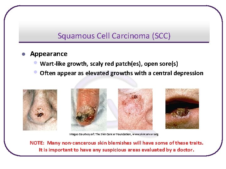 Squamous Cell Carcinoma (SCC) l Appearance • Wart-like growth, scaly red patch(es), open sore(s)