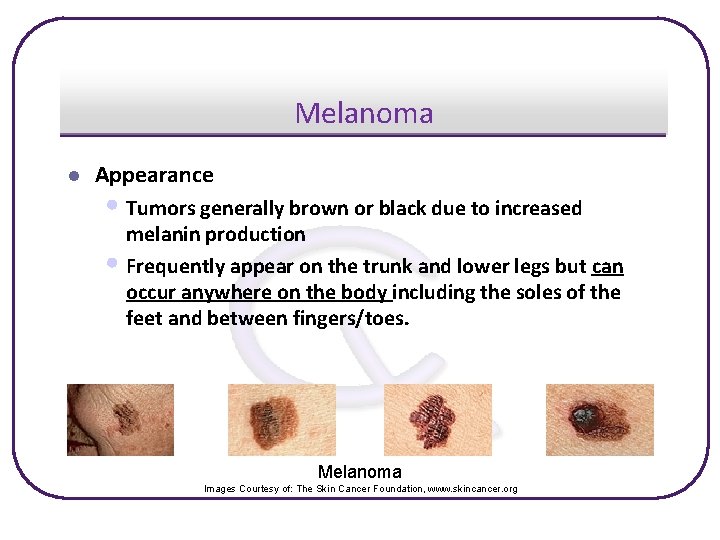 Melanoma l Appearance • Tumors generally brown or black due to increased melanin production