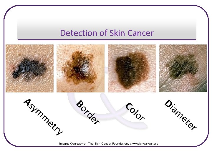 Detection of Skin Cancer er et ry rd m Bo As ym Co lo