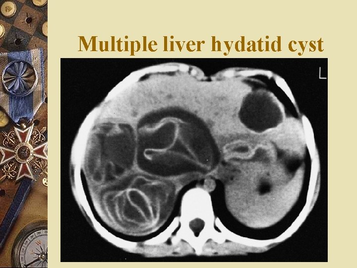 Multiple liver hydatid cyst 