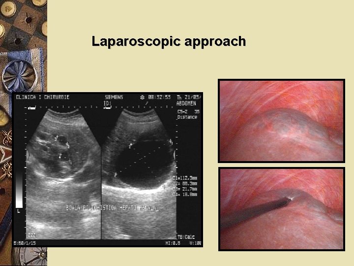 Laparoscopic approach 