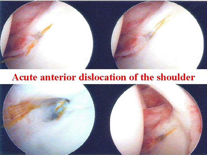 Acute Shoulder Dislocation Surgery Acute anterior dislocation of the shoulder Einoder 