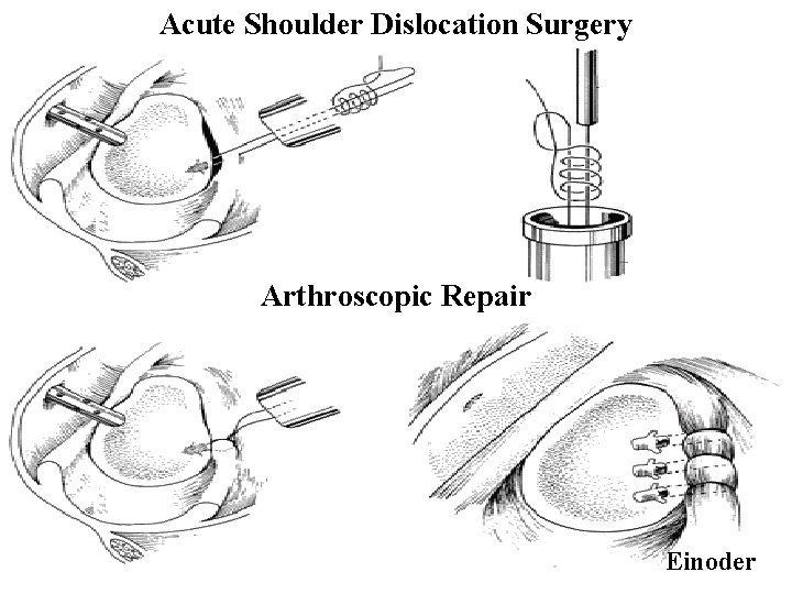 Acute Shoulder Dislocation Surgery Arthroscopic Repair Einoder 