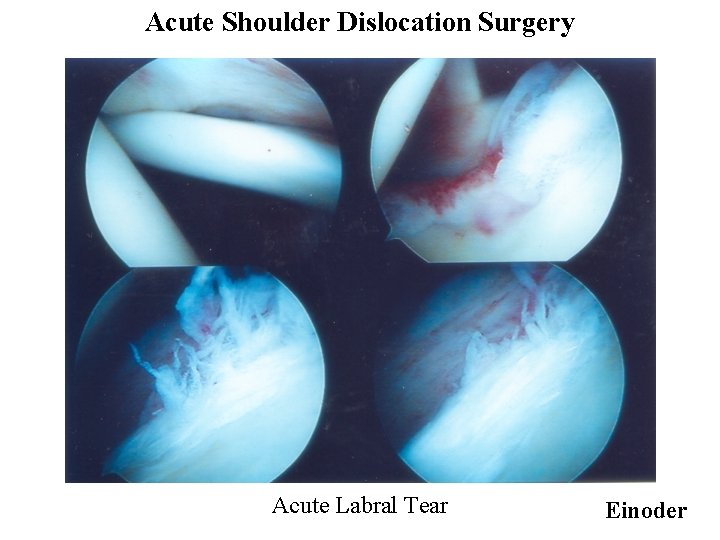 Acute Shoulder Dislocation Surgery Acute Labral Tear Einoder 