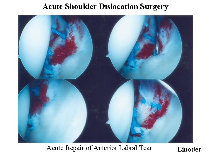 Acute Shoulder Dislocation Surgery Acute Repair of Anterior Labral Tear Einoder 