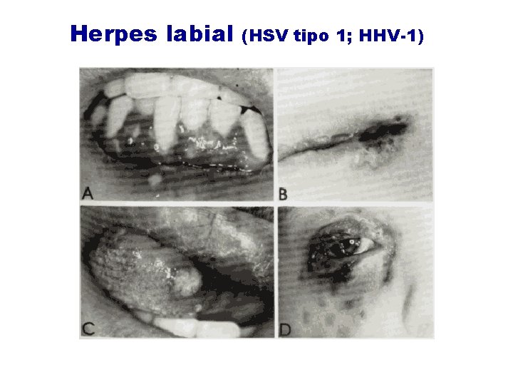 Herpes labial (HSV tipo 1; HHV-1) 