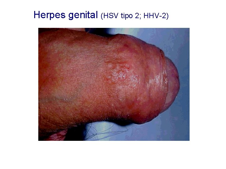 Herpes genital (HSV tipo 2; HHV-2) 