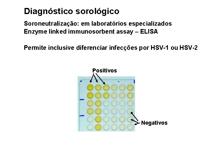 Diagnóstico sorológico Soroneutralização: em laboratórios especializados Enzyme linked immunosorbent assay – ELISA Permite inclusive