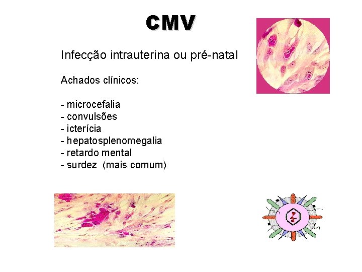 CMV Infecção intrauterina ou pré-natal Achados clínicos: - microcefalia - convulsões - icterícia -