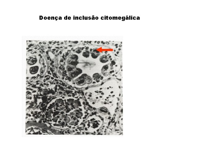 Doença de inclusão citomegálica 