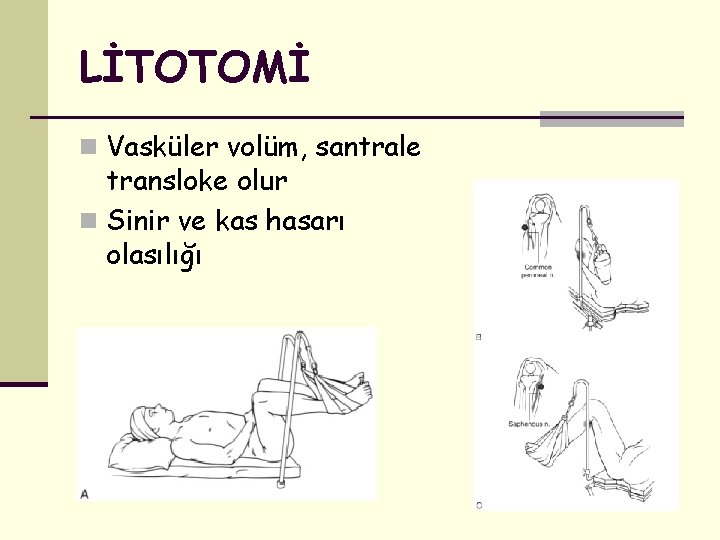 LİTOTOMİ n Vasküler volüm, santrale transloke olur n Sinir ve kas hasarı olasılığı 