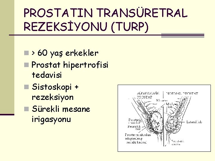 PROSTATIN TRANSÜRETRAL REZEKSİYONU (TURP) n > 60 yaş erkekler n Prostat hipertrofisi tedavisi n