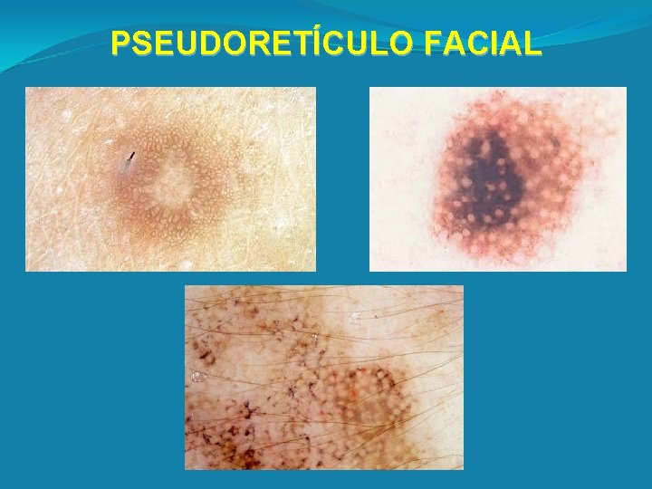 PSEUDORETÍCULO FACIAL 