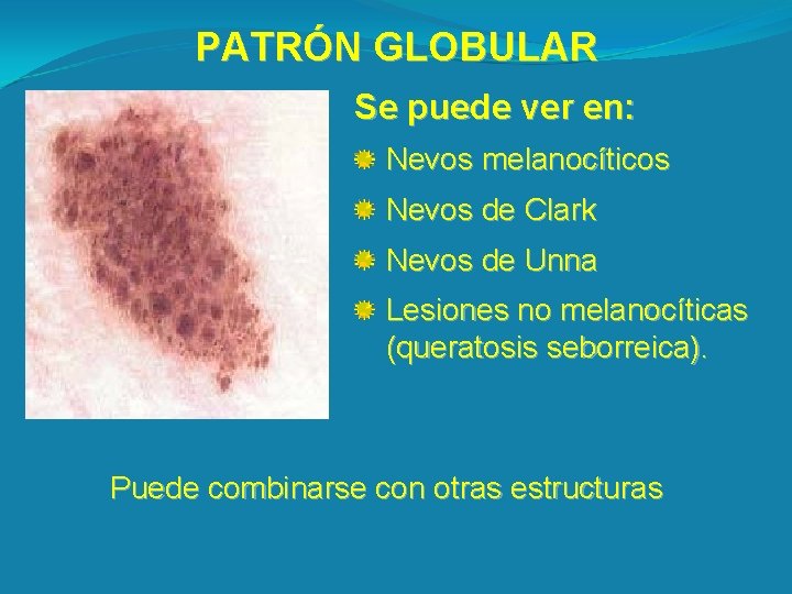 PATRÓN GLOBULAR Se puede ver en: Nevos melanocíticos Nevos de Clark Nevos de Unna