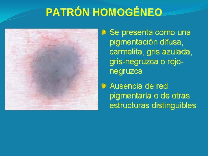 PATRÓN HOMOGÉNEO Se presenta como una pigmentación difusa, carmelita, gris azulada, gris-negruzca o rojonegruzca