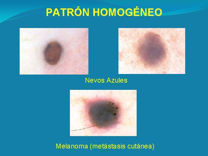 PATRÓN HOMOGÉNEO Nevos Azules Melanoma (metástasis cutánea) 