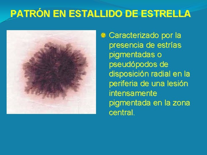 PATRÓN EN ESTALLIDO DE ESTRELLA Caracterizado por la presencia de estrías pigmentadas o pseudópodos