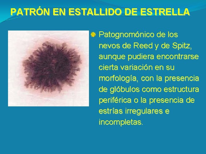 PATRÓN EN ESTALLIDO DE ESTRELLA Patognomónico de los nevos de Reed y de Spitz,