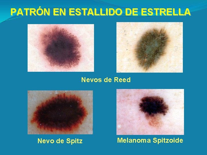 PATRÓN EN ESTALLIDO DE ESTRELLA Nevos de Reed Nevo de Spitz Melanoma Spitzoide 