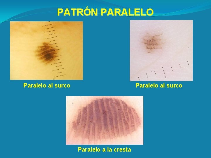 PATRÓN PARALELO Paralelo al surco Paralelo a la cresta 