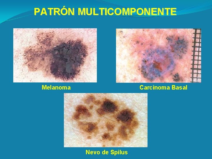 PATRÓN MULTICOMPONENTE Melanoma Carcinoma Basal Nevo de Spilus 